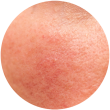 Weak Skin Barrier